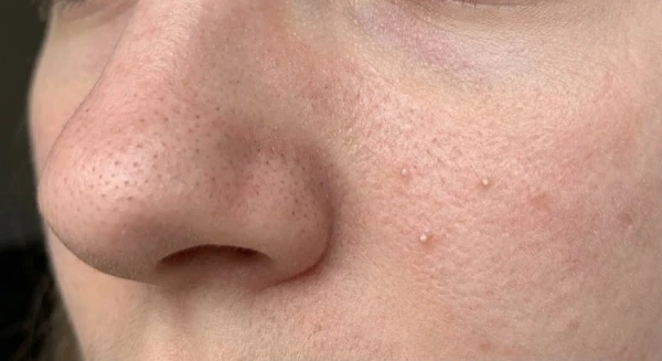 Blackheads and whiteheads