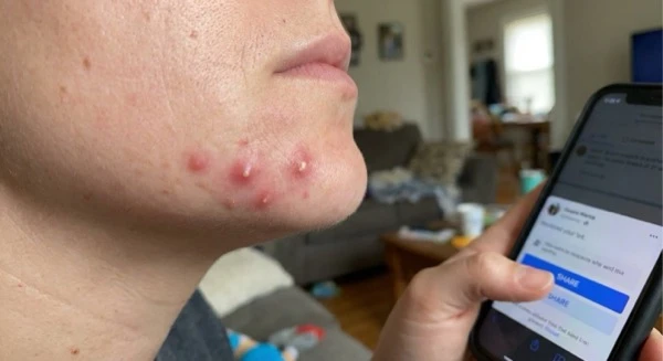 Cystic acne