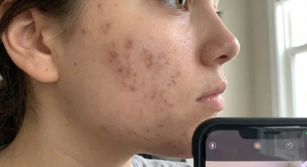 Post-acne scarring
