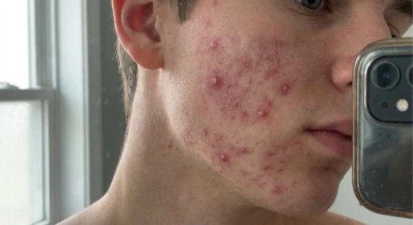 Redness and inflammation